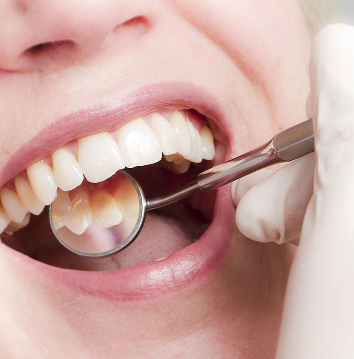 Parodontose und Zahnfleischentzündung Ilsfeld